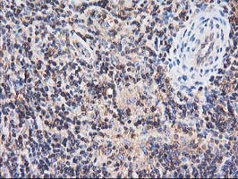 HARS2 Antibody - IHC of paraffin-embedded Human lymphoma tissue using anti-HARS2 mouse monoclonal antibody.
