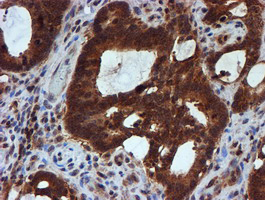 HARS2 Antibody - IHC of paraffin-embedded Adenocarcinoma of Human colon tissue using anti-HARS2 mouse monoclonal antibody.