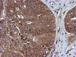 HARS2 Antibody - IHC of paraffin-embedded Adenocarcinoma of Human ovary tissue using anti-HARS2 mouse monoclonal antibody.