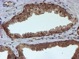 HARS2 Antibody - IHC of paraffin-embedded Carcinoma of Human prostate tissue using anti-HARS2 mouse monoclonal antibody.