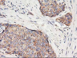 HARS2 Antibody - IHC of paraffin-embedded Adenocarcinoma of Human breast tissue using anti-HARS2 mouse monoclonal antibody.