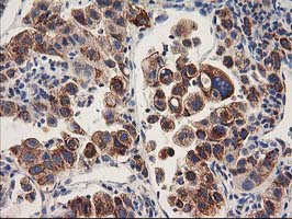 HARS2 Antibody - IHC of paraffin-embedded Carcinoma of Human lung tissue using anti-HARS2 mouse monoclonal antibody.