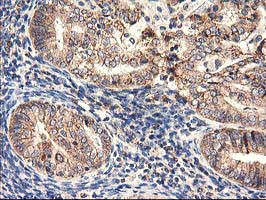 HARS2 Antibody - IHC of paraffin-embedded Adenocarcinoma of Human endometrium tissue using anti-HARS2 mouse monoclonal antibody.