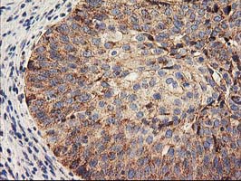 HARS2 Antibody - IHC of paraffin-embedded Carcinoma of Human bladder tissue using anti-HARS2 mouse monoclonal antibody.