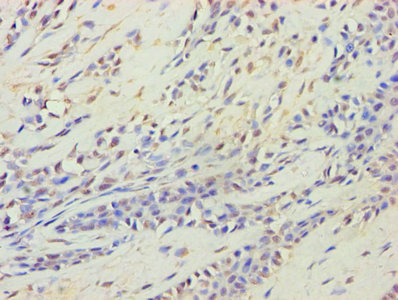HARS2 Antibody - Immunohistochemistry of paraffin-embedded human breast cancer using HARS2 Antibody at dilution of 1:100