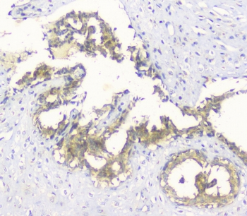 HAS1 / HAS Antibody - IHC staining of FFPE human breast cancer with HAS1 antibody at 1ug/ml. HIER: boil tissue sections in pH6, 10mM citrate buffer, for 10-20 min and allow to cool before testing.
