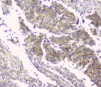 HAS1 / HAS Antibody - IHC staining of FFPE human lung cancer with HAS1 antibody at 1ug/ml. HIER: boil tissue sections in pH6, 10mM citrate buffer, for 10-20 min and allow to cool before testing.