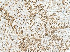 HAS1 / HAS Antibody - Immunohistochemistry of paraffin-embedded Human ovarian cancer tissue  using HAS1 Polyclonal Antibody at dilution of 1:70(×200)