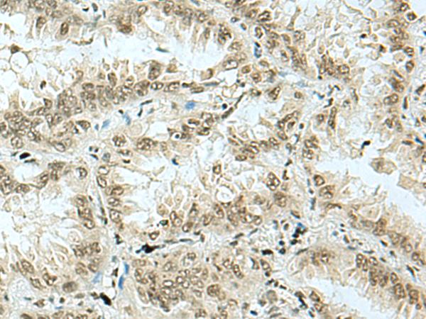 HAS1 / HAS Antibody - Immunohistochemistry of paraffin-embedded Human lung cancer tissue  using HAS1 Polyclonal Antibody at dilution of 1:70(×200)
