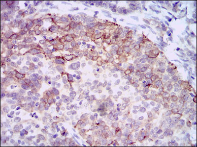 HAS3 Antibody - IHC of paraffin-embedded cervical cancer tissues using HAS3 mouse monoclonal antibody with DAB staining.