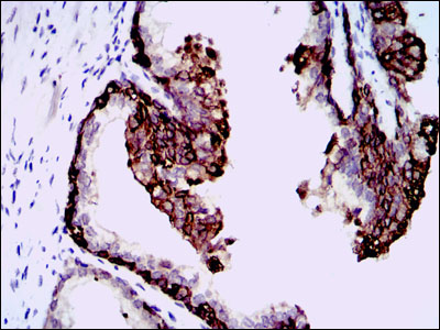 HAS3 Antibody - IHC of paraffin-embedded prostate tissues using HAS3 mouse monoclonal antibody with DAB staining.