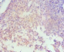 HAS3 Antibody - Immunohistochemistry of paraffin-embedded human cervical cancer using antibody at 1:100 dilution.