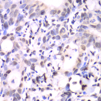 HAT1 Antibody - Immunohistochemistry of paraffin-embedded human gastric cancer tissue.