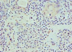 HAT1 Antibody - Immunohistochemistry of paraffin-embedded human breast cancer using antibody at 1:100 dilution.