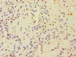 HAUS3 / C4orf15 Antibody - Immunohistochemistry of paraffin-embedded human breast cancer using antibody at 1:100 dilution.