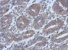 HAUS4 Antibody - IHC of paraffin-embedded Colon ca, using C14orf94 antibody at 1:500 dilution.