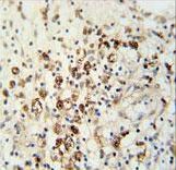 HAUS5 Antibody - HAUS5 Antibody immunohistochemistry of formalin-fixed and paraffin-embedded human colon carcinoma followed by peroxidase-conjugated secondary antibody and DAB staining.
