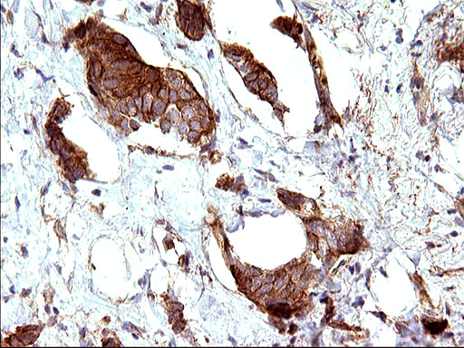 HAUS7 Antibody - IHC of paraffin-embedded Adenocarcinoma of Human breast tissue using anti-HAUS7 mouse monoclonal antibody. (Heat-induced epitope retrieval by 10mM citric buffer, pH6.0, 120°C for 3min).