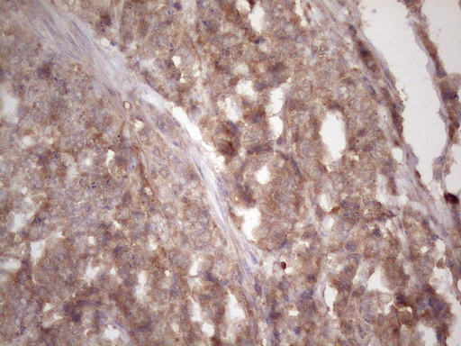 HAVCR2 / TIM-3 Antibody - Immunohistochemical staining of paraffin-embedded Adenocarcinoma of Human endometrium tissue using anti-HAVCR2 mouse monoclonal antibody. (Heat-induced epitope retrieval by 1 mM EDTA in 10mM Tris, pH8.5, 120C for 3min. (1:150)