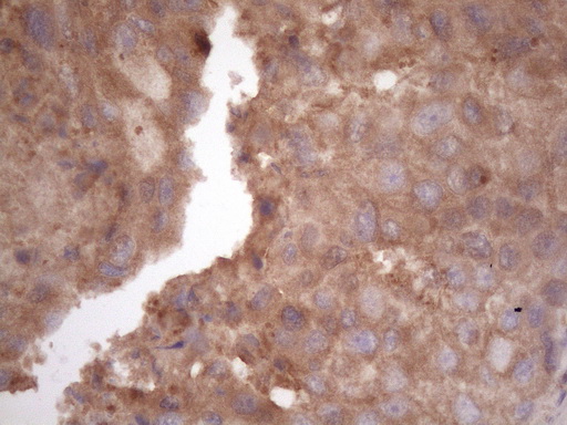 HAVCR2 / TIM-3 Antibody - Immunohistochemical staining of paraffin-embedded Adenocarcinoma of Human breast tissue using anti-HAVCR2 mouse monoclonal antibody. (Heat-induced epitope retrieval by 1 mM EDTA in 10mM Tris, pH8.5, 120C for 3min. (1:150)