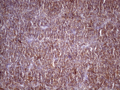 HAVCR2 / TIM-3 Antibody - Immunohistochemical staining of paraffin-embedded Human lymphoma tissue using anti-HAVCR2 mouse monoclonal antibody. (Heat-induced epitope retrieval by 1 mM EDTA in 10mM Tris, pH8.5, 120C for 3min. (1:150)