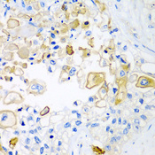 HAVCR2 / TIM-3 Antibody - Immunohistochemistry of paraffin-embedded human lung cancer tissue.