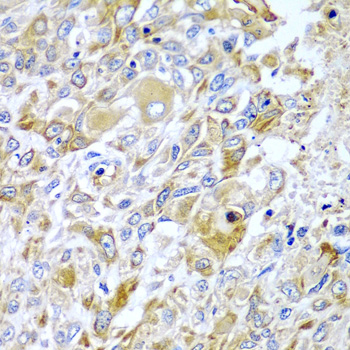HAVCR2 / TIM-3 Antibody - Immunohistochemistry of paraffin-embedded human lung cancer tissue.