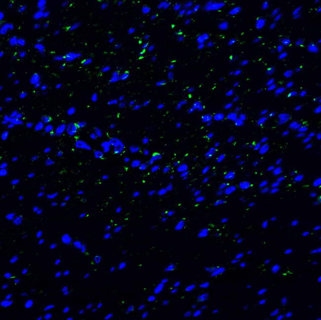 HAVCR2 / TIM-3 Antibody - Immunofluorescence of TIM-3 in human colon carcinoma tissue with TIM-3 antibody at 20 ug/mL. Green: TIM-3 Antibody [10C10] Blue: DAPI staining