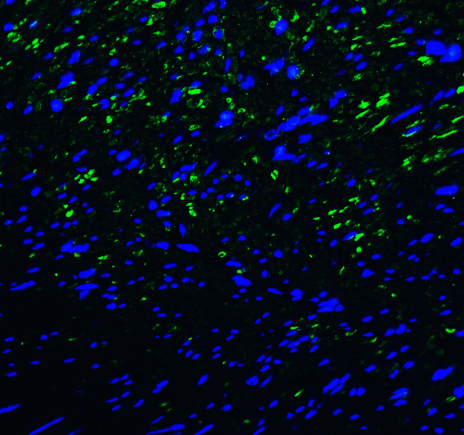 HAVCR2 / TIM-3 Antibody - Immunofluorescence of TIM-3 in human colon carcinoma tissue with TIM-3 antibody at 20 ug/mL. Green: TIM-3 Antibody [1B10] Blue: DAPI staining