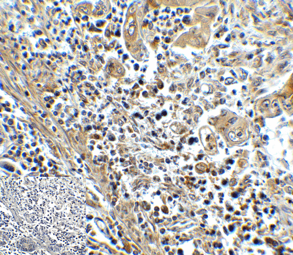 HAVCR2 / TIM-3 Antibody - Immunohistochemistry of TIM-3 in human colon carcinoma tissue with TIM-3 antibody at 5 ug/mL.