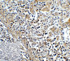 HAVCR2 / TIM-3 Antibody - Immunohistochemistry of TIM-3 in human colon carcinoma tissue with TIM-3 antibody at 5 ug/mL.