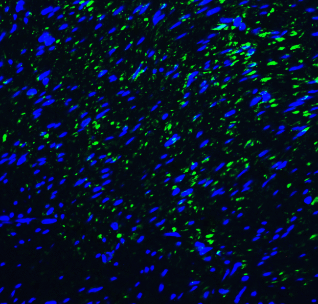 HAVCR2 / TIM-3 Antibody - Immunofluorescence of TIM-3 in human colon carcinoma tissue with TIM-3 antibody at 20 ug/mL. Green: TIM-3 Antibody [1C6] Blue: DAPI staining