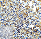 HAVCR2 / TIM-3 Antibody - Immunohistochemistry of TIM-3 in human colon carcinoma tissue with TIM-3 antibody at 5 ug/mL.