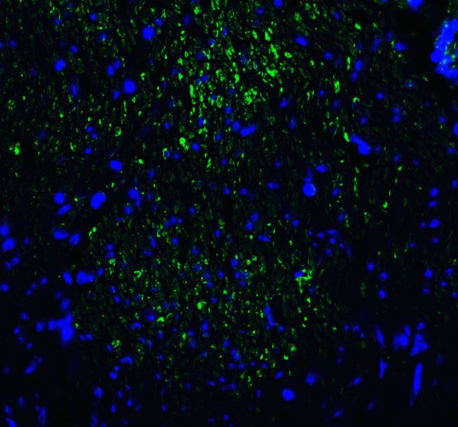 HAVCR2 / TIM-3 Antibody - Immunofluorescence of TIM-3 in human colon carcinoma tissue with TIM-3 antibody at 20 ug/mL. Green: TIM-3 Antibody [2A6] Blue: DAPI staining