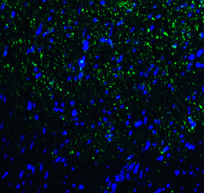HAVCR2 / TIM-3 Antibody - Immunofluorescence of TIM-3 in human colon carcinoma tissue with TIM-3 antibody at 20 ug/mL. Green: TIM-3 Antibody [3G7] Blue: DAPI staining