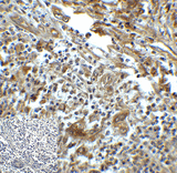 HAVCR2 / TIM-3 Antibody - Immunohistochemistry of TIM-3 in human colon carcinoma tissue with TIM-3 antibody at 5 ug/mL.