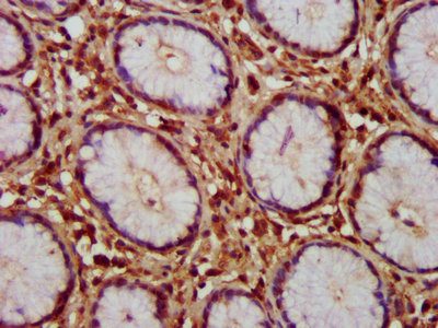HAX-1 Antibody - IHC image of HAX1 Antibody diluted at 1:150 and staining in paraffin-embedded human stomach cancer performed on a Leica BondTM system. After dewaxing and hydration, antigen retrieval was mediated by high pressure in a citrate buffer (pH 6.0). Section was blocked with 10% normal goat serum 30min at RT. Then primary antibody (1% BSA) was incubated at 4°C overnight. The primary is detected by a biotinylated secondary antibody and visualized using an HRP conjugated SP system.