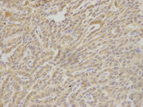 HAX-1 Antibody - Immunohistochemistry of paraffin-embedded human thyroid cancer using HAX1 antibody at dilution of 1:200 (400x lens).
