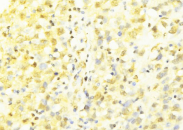 HAX-1 Antibody - 1:100 staining human breast carcinoma tissue by IHC-P. The sample was formaldehyde fixed and a heat mediated antigen retrieval step in citrate buffer was performed. The sample was then blocked and incubated with the antibody for 1.5 hours at 22°C. An HRP conjugated goat anti-rabbit antibody was used as the secondary.