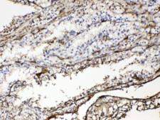 HBA1+2 / Hemoglobin Alpha Antibody - IHC testing of FFPE human renal cancer tissue with Hemoglobin antibody at 1ug/ml. Required HIER: steam section in pH6 citrate buffer for 20 min and allow to cool prior to testing.