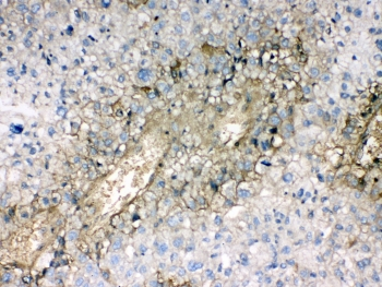 HBA1+2 / Hemoglobin Alpha Antibody - IHC testing of FFPE human liver cancer tissue with Hemoglobin antibody at 1ug/ml. Required HIER: steam section in pH6 citrate buffer for 20 min and allow to cool prior to testing.