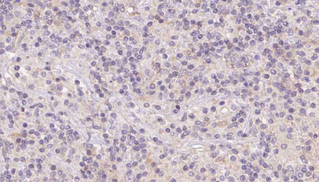 HBE1 / Hemoglobin Epsilon 1 Antibody - 1:100 staining human lymph carcinoma tissue by IHC-P. The sample was formaldehyde fixed and a heat mediated antigen retrieval step in citrate buffer was performed. The sample was then blocked and incubated with the antibody for 1.5 hours at 22°C. An HRP conjugated goat anti-rabbit antibody was used as the secondary.