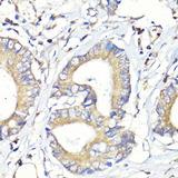 HBEGF / HB EGF Antibody - Immunohistochemistry of paraffin-embedded Human colon carcinoma using HBEGF Polyclonal Antibody at dilution of 1:100 (40x lens).