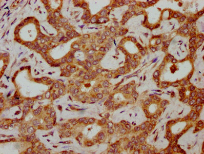 HBG2 / Hemoglobin Gamma 2 Antibody - Immunohistochemistry Dilution at 1:300 and staining in paraffin-embedded human liver cancer performed on a Leica BondTM system. After dewaxing and hydration, antigen retrieval was mediated by high pressure in a citrate buffer (pH 6.0). Section was blocked with 10% normal Goat serum 30min at RT. Then primary antibody (1% BSA) was incubated at 4°C overnight. The primary is detected by a biotinylated Secondary antibody and visualized using an HRP conjugated SP system.
