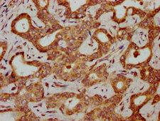 HBG2 / Hemoglobin Gamma 2 Antibody - Immunohistochemistry Dilution at 1:300 and staining in paraffin-embedded human liver cancer performed on a Leica BondTM system. After dewaxing and hydration, antigen retrieval was mediated by high pressure in a citrate buffer (pH 6.0). Section was blocked with 10% normal Goat serum 30min at RT. Then primary antibody (1% BSA) was incubated at 4°C overnight. The primary is detected by a biotinylated Secondary antibody and visualized using an HRP conjugated SP system.