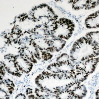 HBP1 Antibody - Immunohistochemical analysis of HBP1 staining in human colon cancer formalin fixed paraffin embedded tissue section. The section was pre-treated using heat mediated antigen retrieval with sodium citrate buffer (pH 6.0). The section was then incubated with the antibody at room temperature and detected using an HRP conjugated compact polymer system. DAB was used as the chromogen. The section was then counterstained with hematoxylin and mounted with DPX.