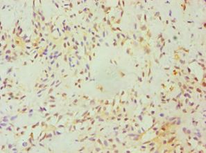 HBP17 / FGFBP1 Antibody - Immunohistochemistry of paraffin-embedded human breast cancer using antibody at 1:100 dilution.