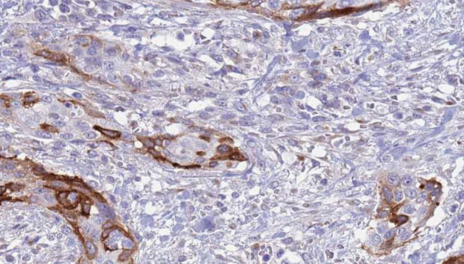 HBP17 / FGFBP1 Antibody - 1:100 staining human urothelial carcinoma tissue by IHC-P. The sample was formaldehyde fixed and a heat mediated antigen retrieval step in citrate buffer was performed. The sample was then blocked and incubated with the antibody for 1.5 hours at 22°C. An HRP conjugated goat anti-rabbit antibody was used as the secondary.