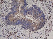 HBS1L Antibody - IHC of paraffin-embedded Adenocarcinoma of Human colon tissue using anti-HBS1L mouse monoclonal antibody. (Heat-induced epitope retrieval by 10mM citric buffer, pH6.0, 100C for 10min).