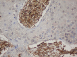HBS1L Antibody - IHC of paraffin-embedded Carcinoma of Human lung tissue using anti-HBS1L mouse monoclonal antibody. (Heat-induced epitope retrieval by 10mM citric buffer, pH6.0, 100C for 10min).